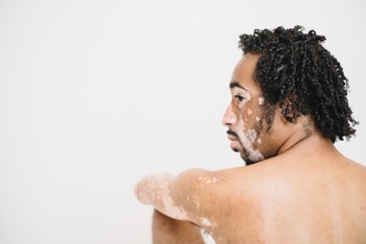 Procura-se pessoas com vitiligo entre os 18 e os 45 anos para campanha fotográfica internacional em Lisboa