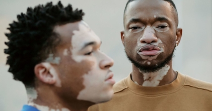 Casting pessoas com vitiligo para projeto publicitario en Portugal