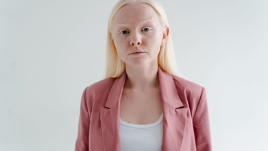 Casting pessoas com albinismo para projeto publicitario en Portugal
