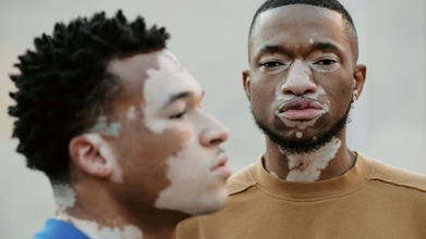 Casting pessoas com vitiligo para projeto publicitario en Portugal